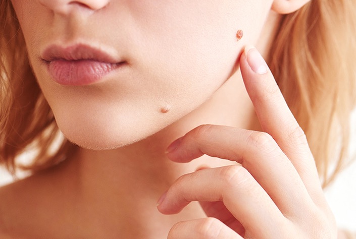 Moles And Skin Tag Removal Derma Health